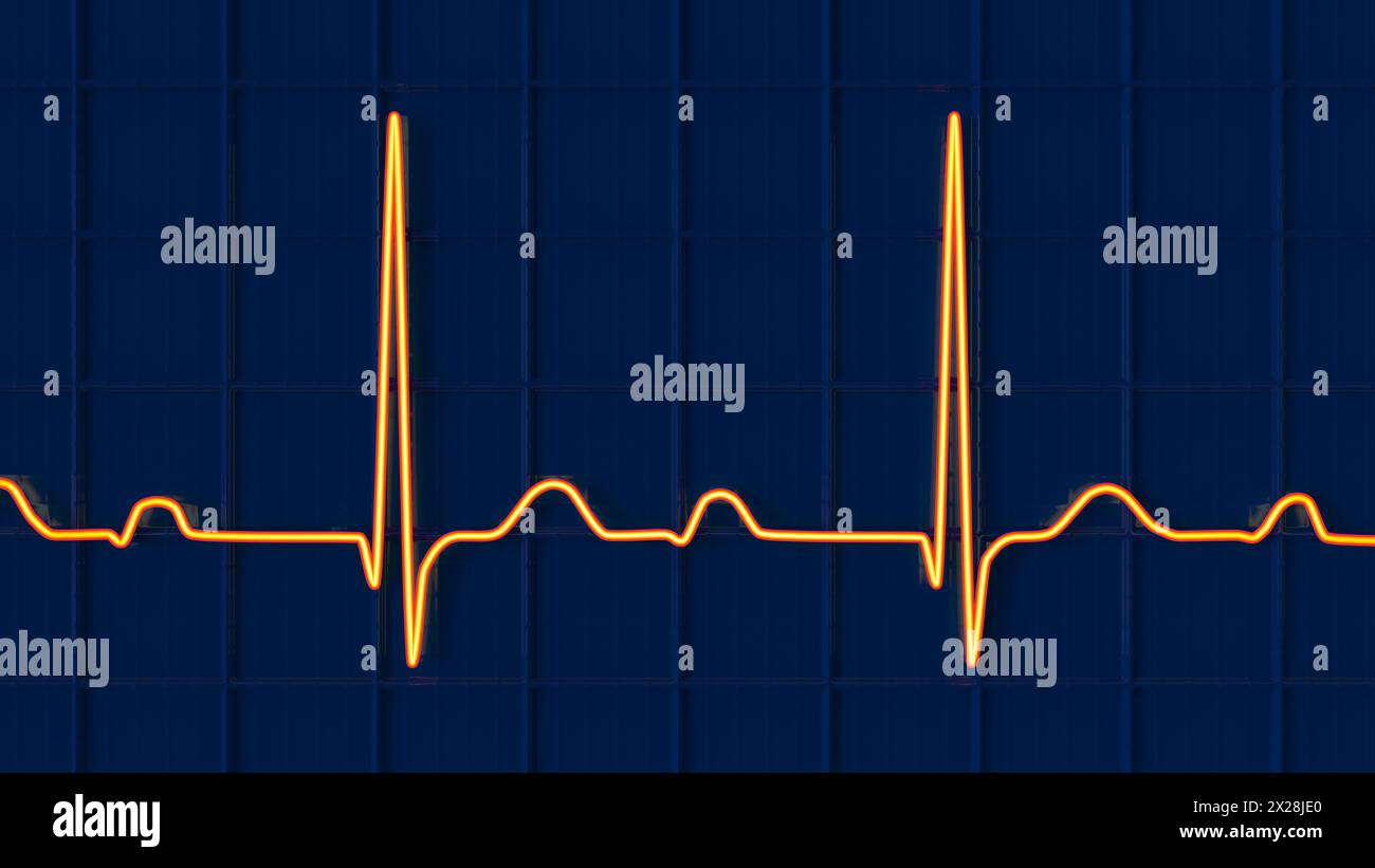 ECG displaying first degree AV block, illustration Stock Photo