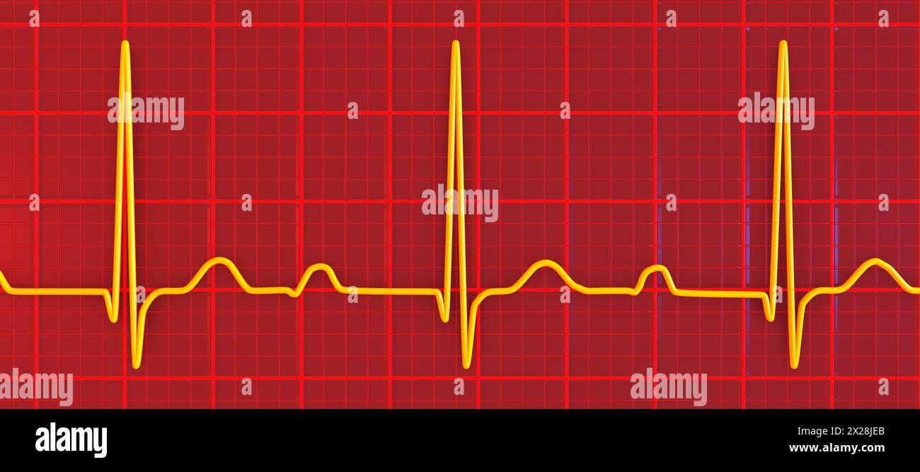 ECG displaying first degree AV block, illustration Stock Photo - Alamy