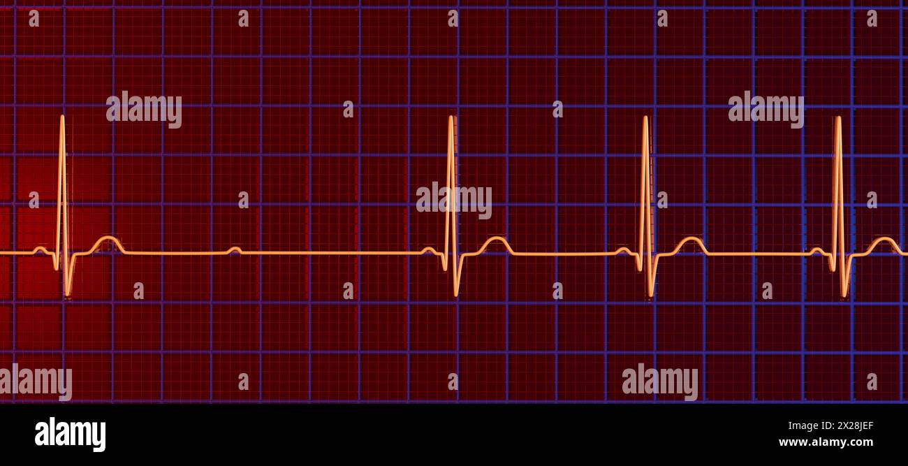 ECG with second degree Mobitz 2 AV block, illustration Stock Photo - Alamy