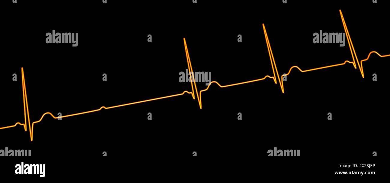 ECG with second degree Mobitz 2 AV block, illustration Stock Photo