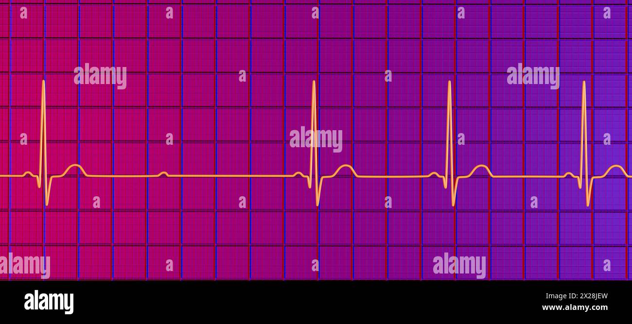 ECG with second degree Mobitz 2 AV block, illustration Stock Photo