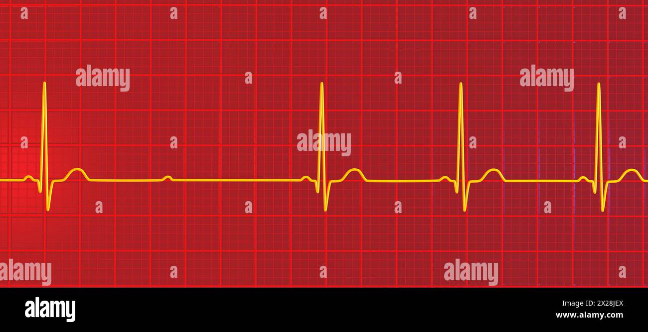 ECG with second degree Mobitz 2 AV block, illustration Stock Photo