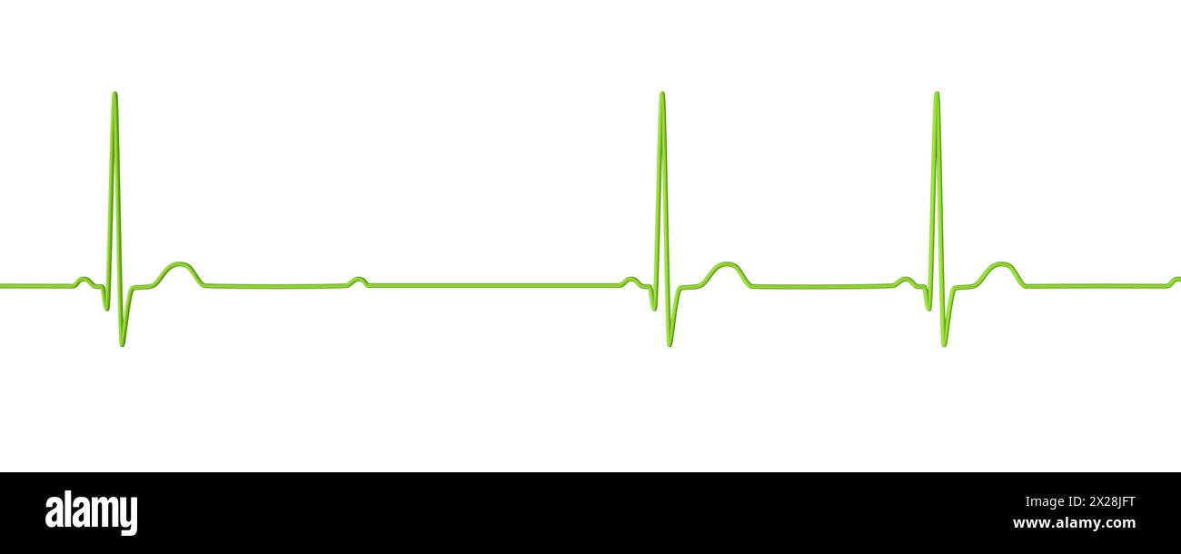 ECG with second degree Mobitz 2 AV block, illustration Stock Photo