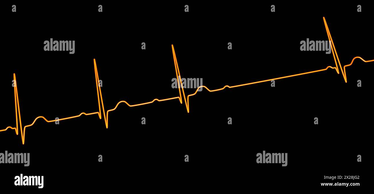 ECG with second degree AV block, illustration Stock Photo