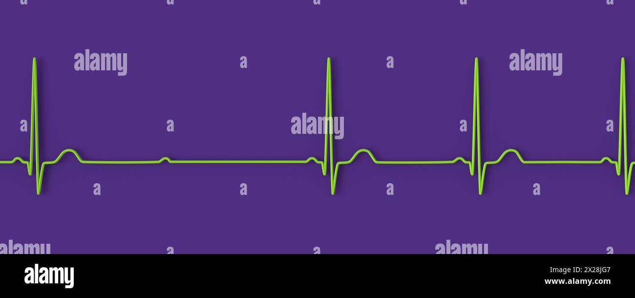 ECG with second degree Mobitz 2 AV block, illustration Stock Photo