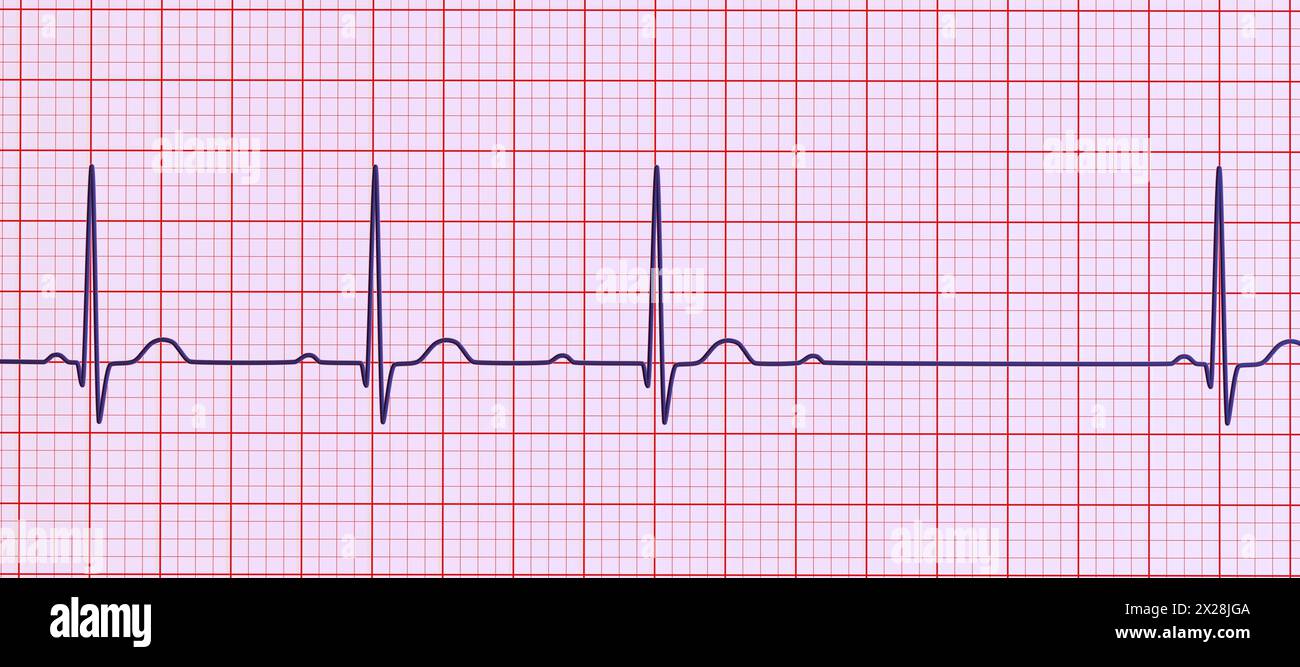 ECG with second degree AV block, illustration Stock Photo