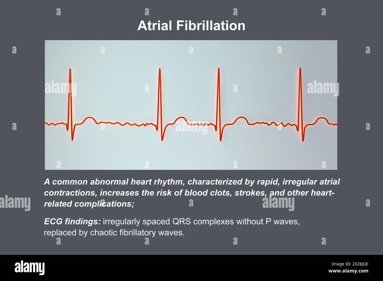 ECG in atrial fibrillation, illustration Stock Photo