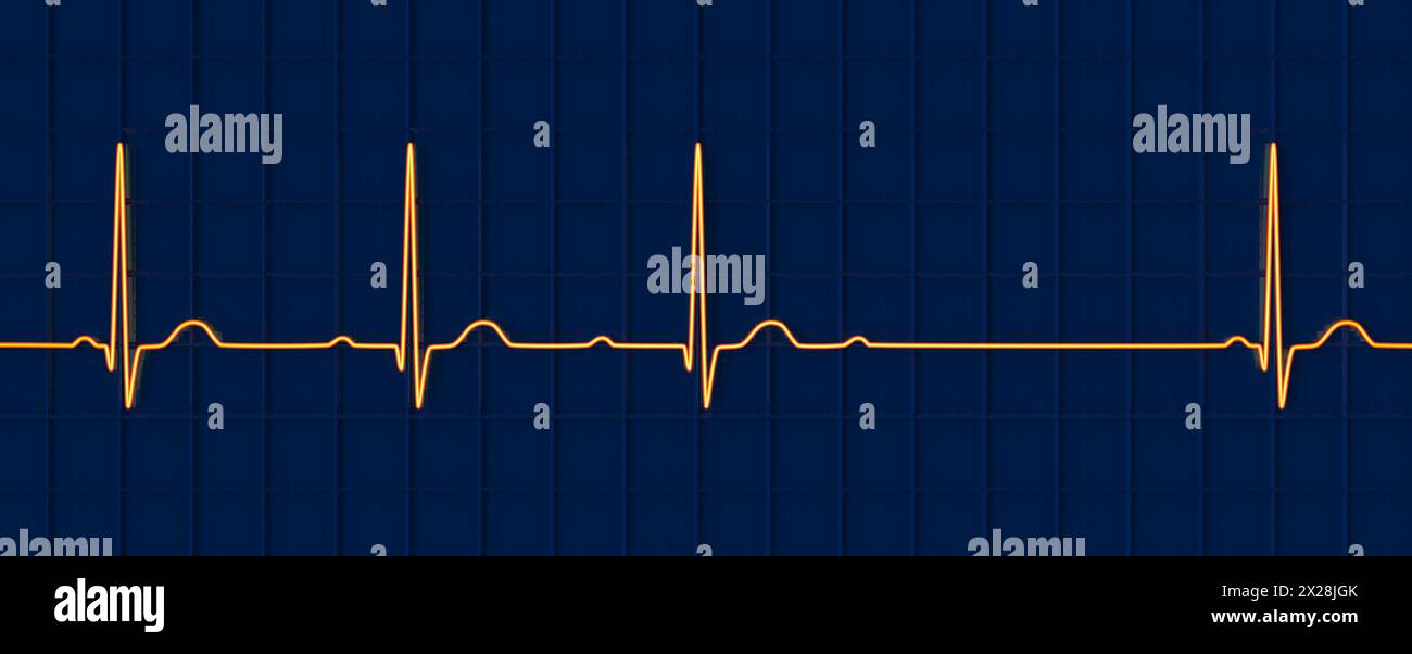 ECG with second degree AV block, illustration Stock Photo