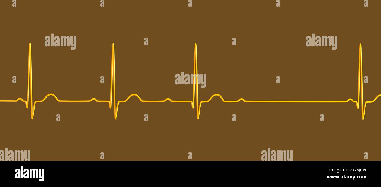 ECG with second degree AV block, illustration Stock Photo