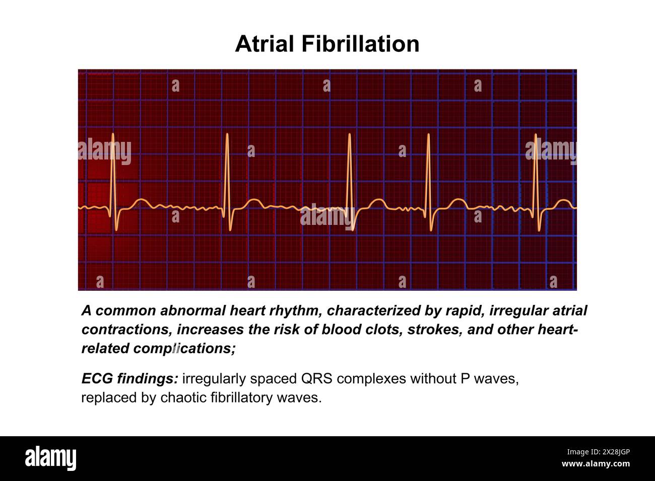 ECG in atrial fibrillation, illustration Stock Photo