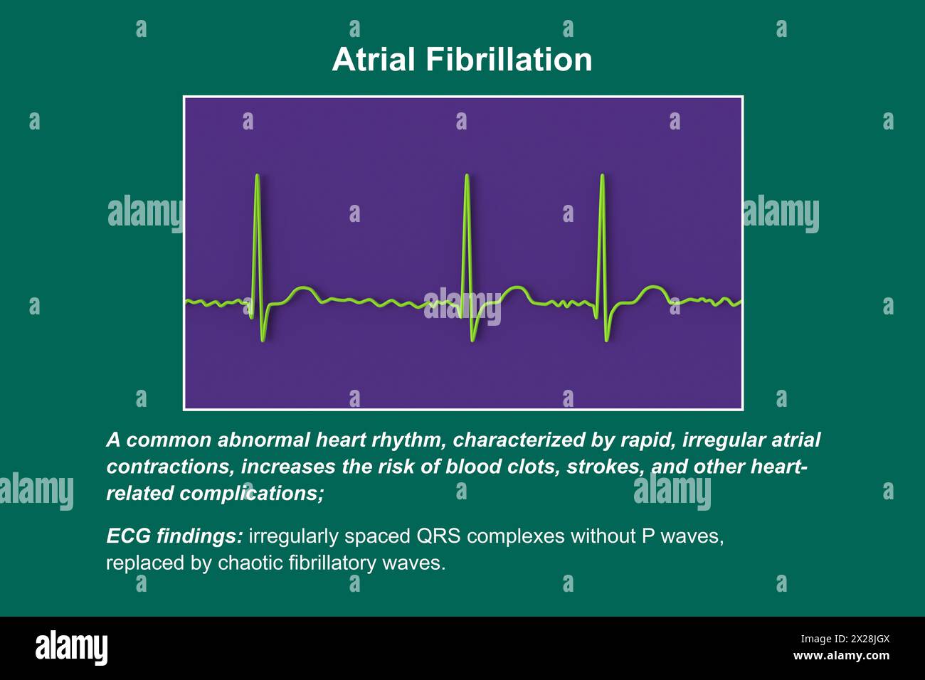 ECG in atrial fibrillation, illustration Stock Photo