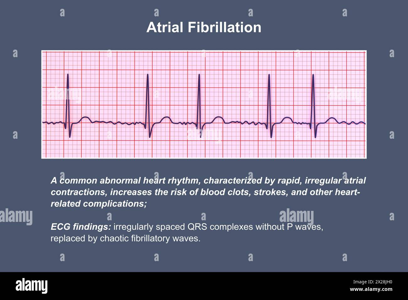 ECG in atrial fibrillation, illustration Stock Photo