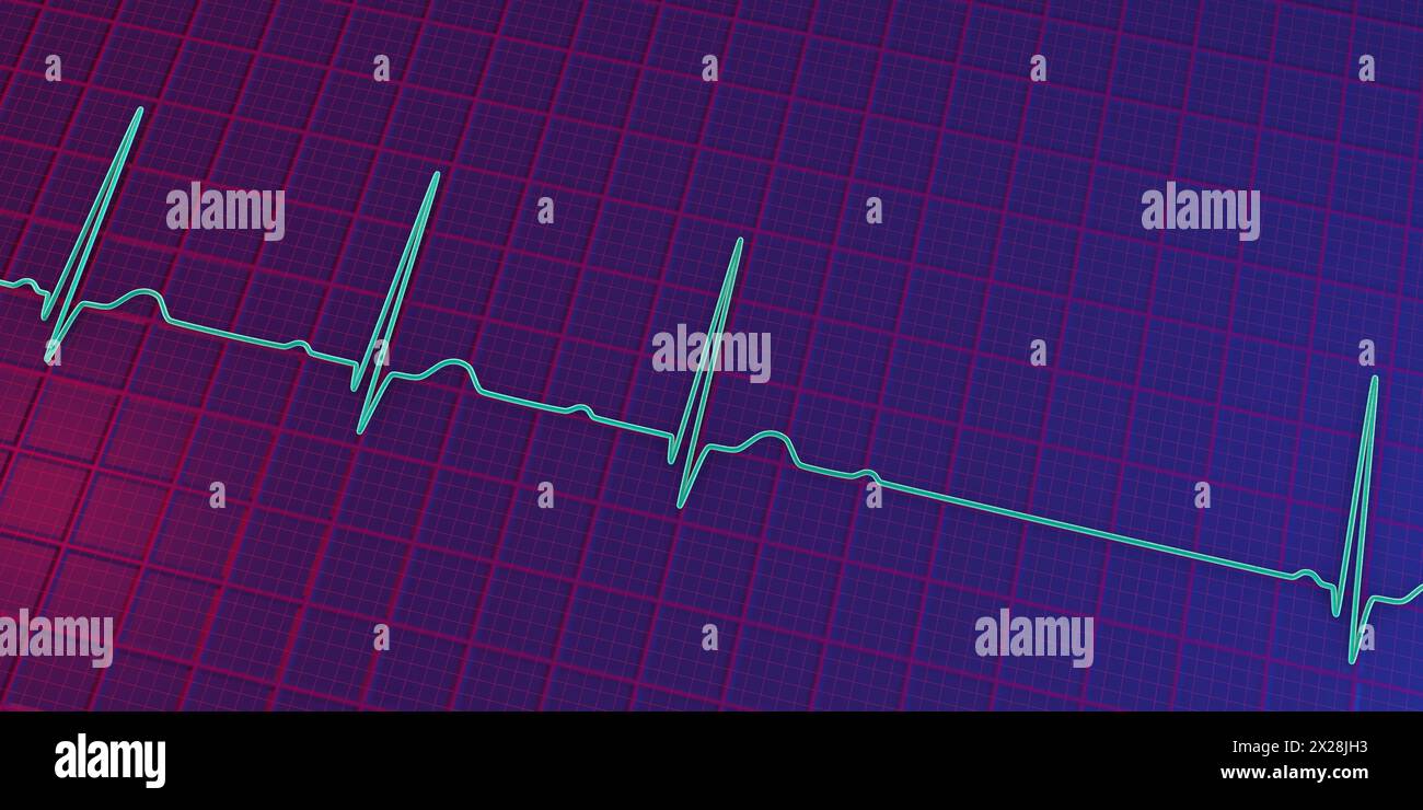 ECG with second degree AV block, illustration Stock Photo