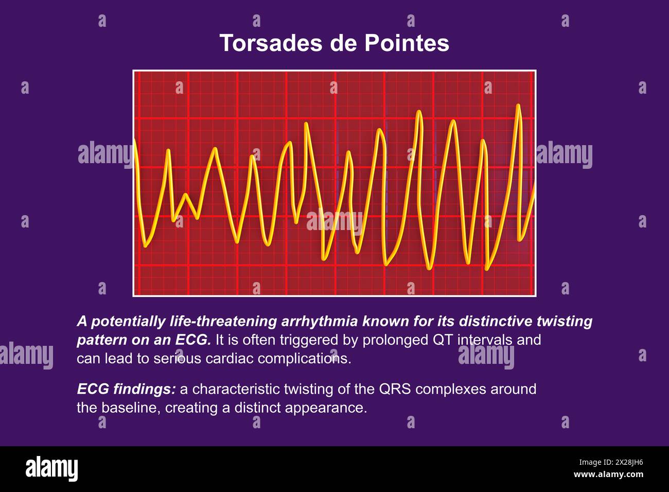 ECG displaying Torsades de pointes rhythm, illustration Stock Photo