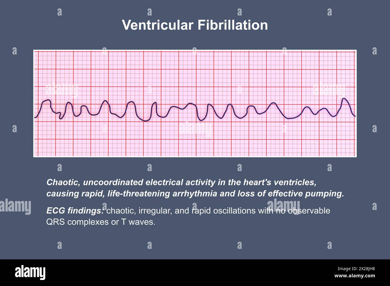 ECG in ventricular fibrillation, illustration Stock Photo