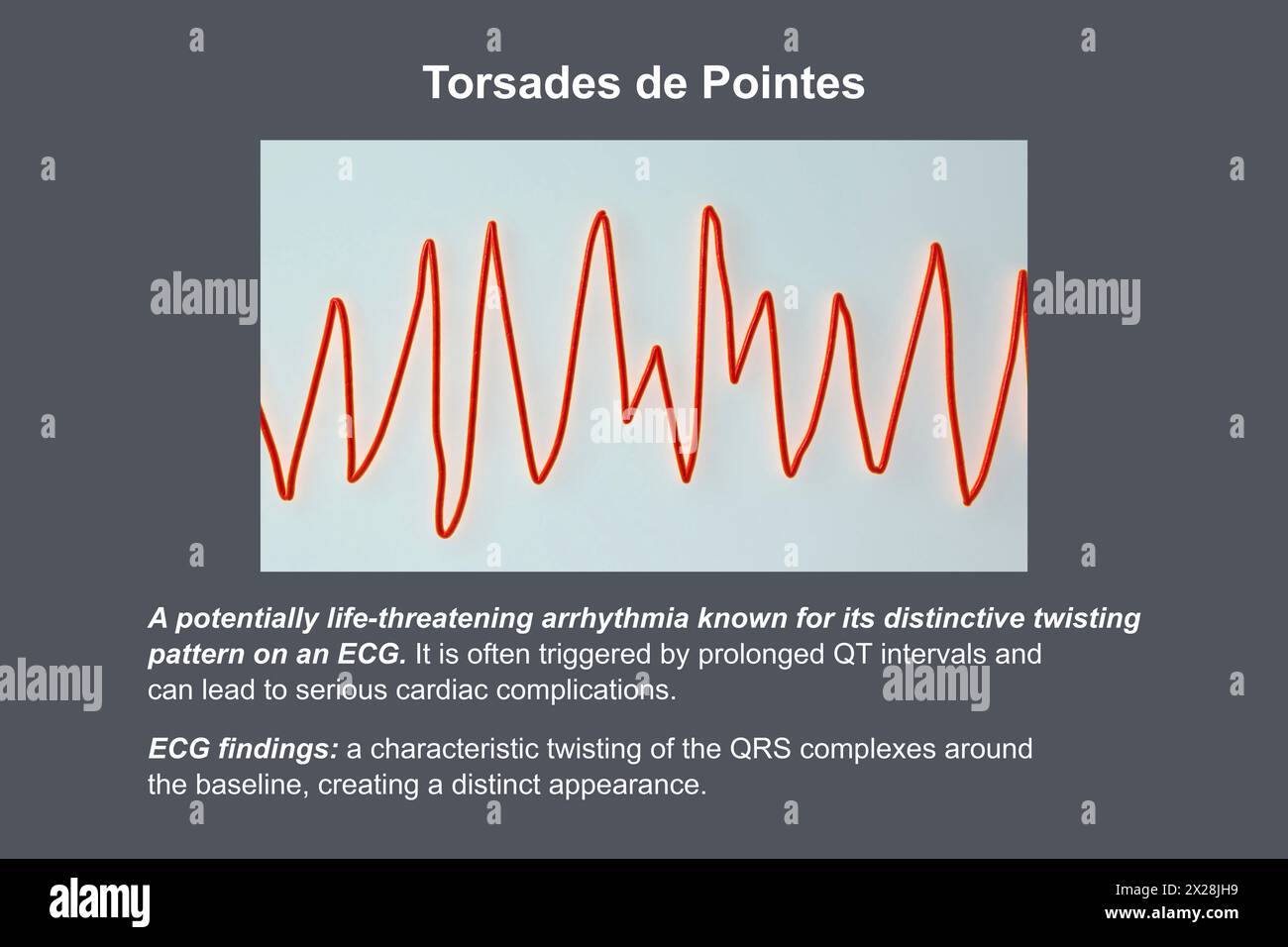 ECG displaying Torsades de pointes rhythm, illustration Stock Photo