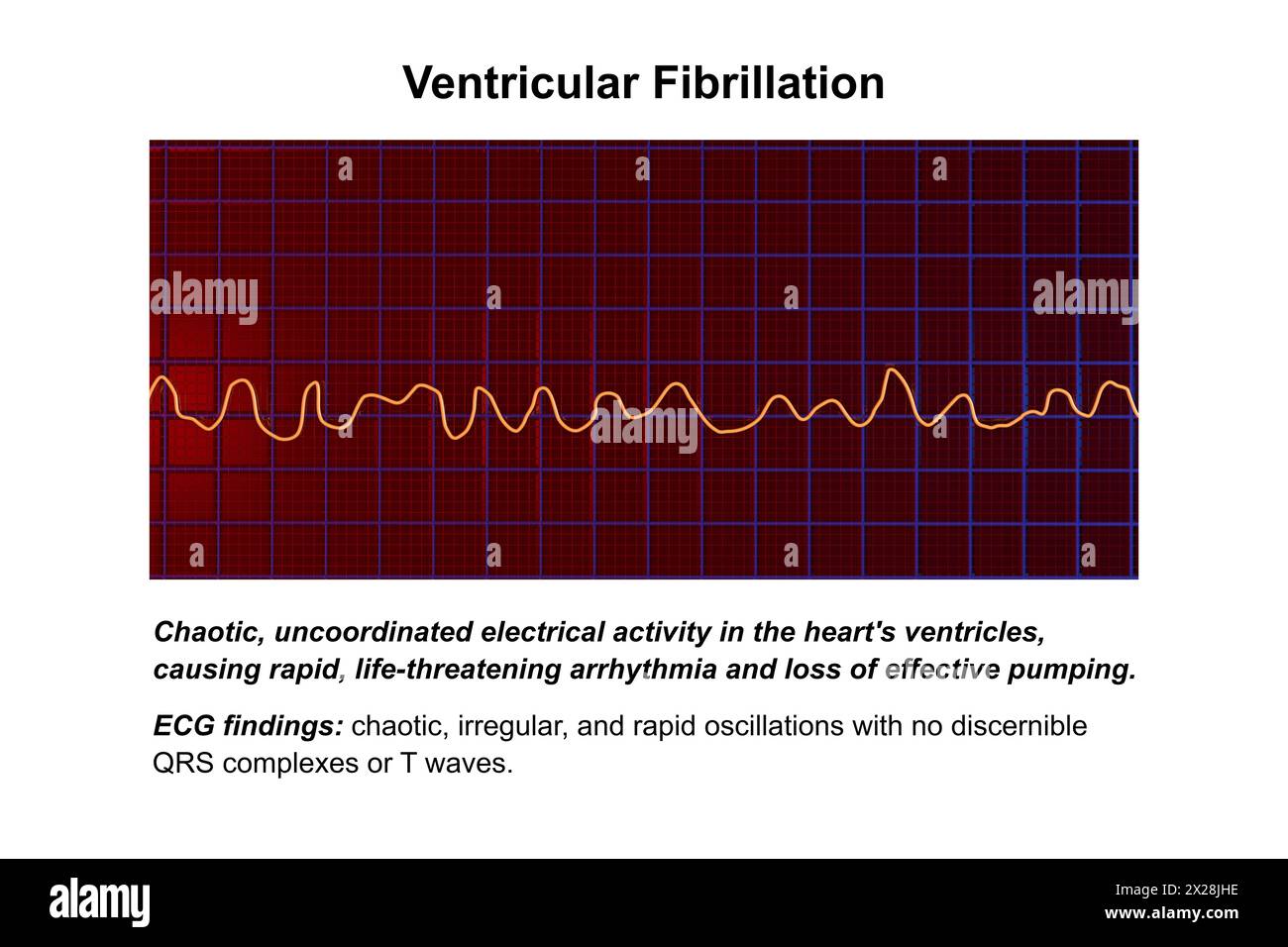 ECG in ventricular fibrillation, illustration Stock Photo