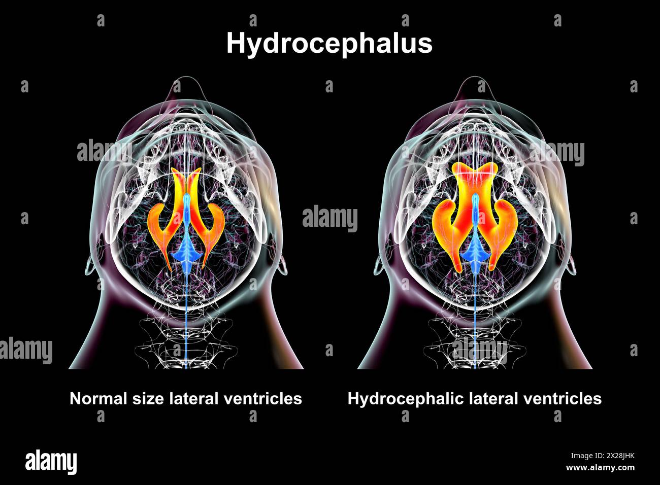 Enlarged and normal lateral ventricles, illustration Stock Photo