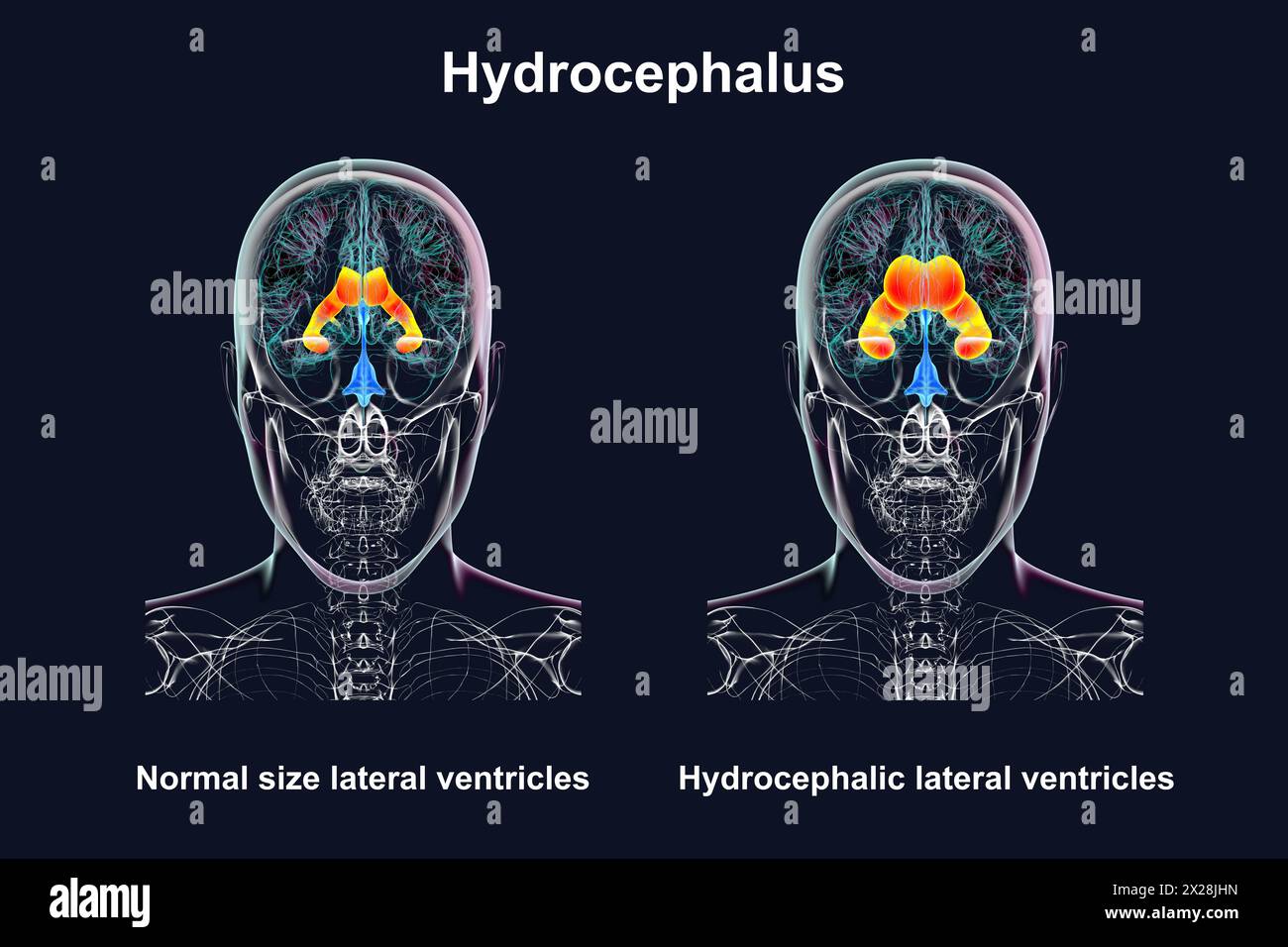 Enlarged and normal lateral ventricles, illustration Stock Photo