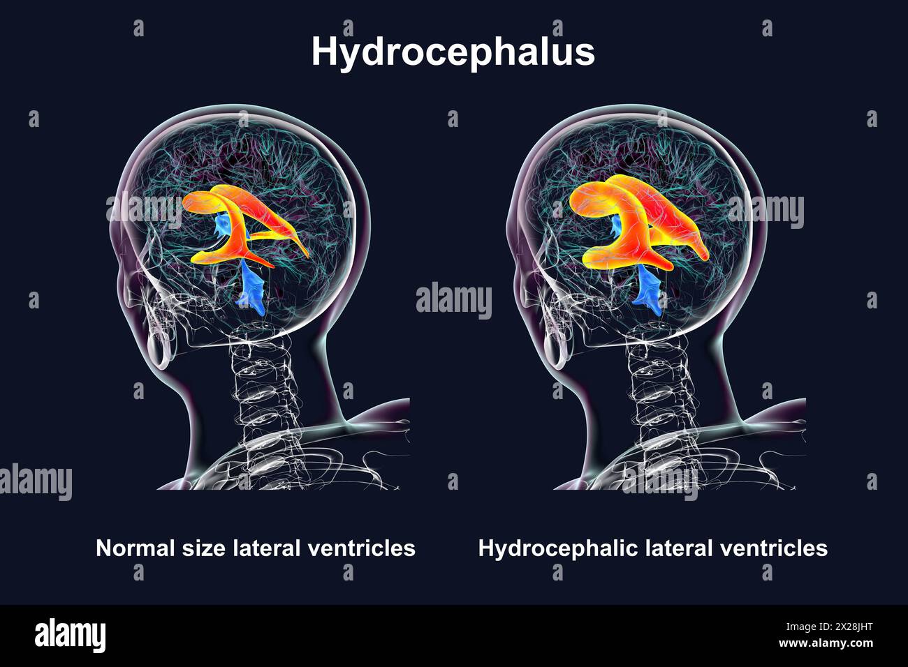 Enlarged and normal lateral ventricles, illustration Stock Photo