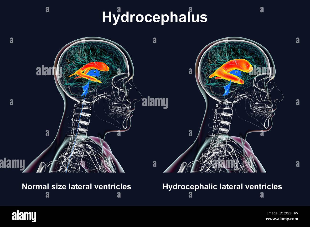 Enlarged and normal lateral ventricles, illustration Stock Photo