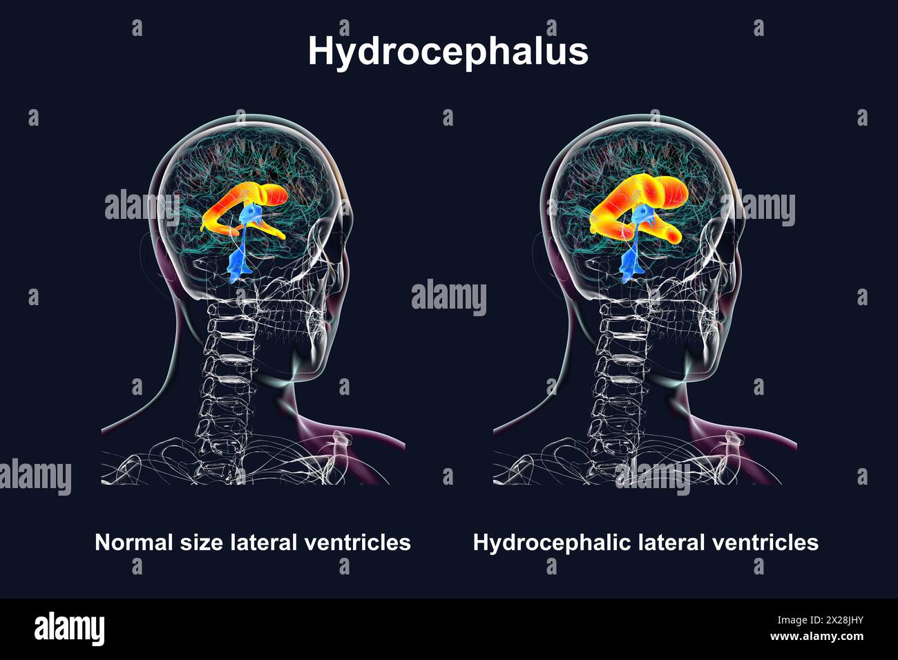 Enlarged and normal lateral ventricles, illustration Stock Photo