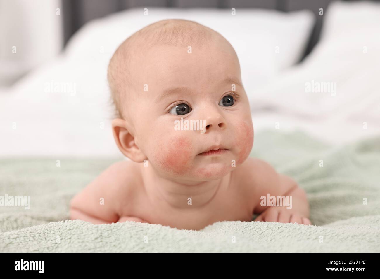 Cute little baby with allergic redness on cheeks lying on bed at home