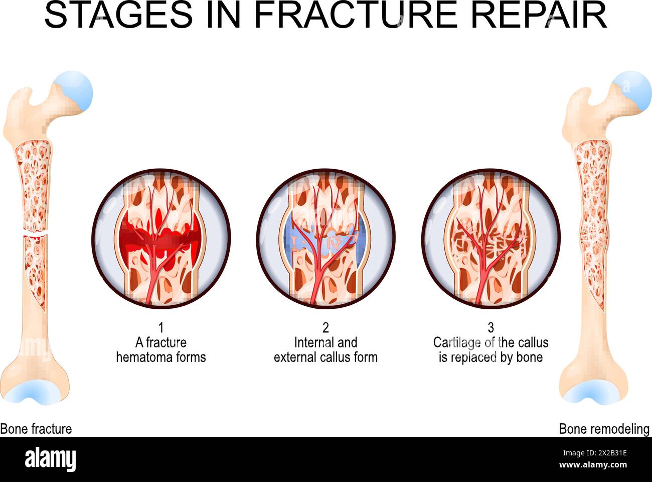 Stages in fracture repair. From Bone fracture and hematoma forms to Cartilage of the callus is replaced by bone and Bone remodeling. Vector illustrati Stock Vector