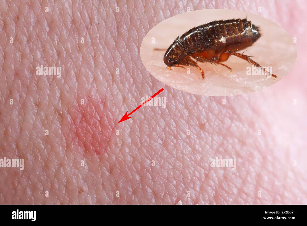 The flea feeds on human skin. Painful flea bite Stock Photo - Alamy