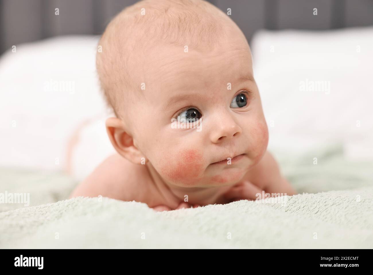 Cute little baby with allergic redness on cheeks lying on bed at home