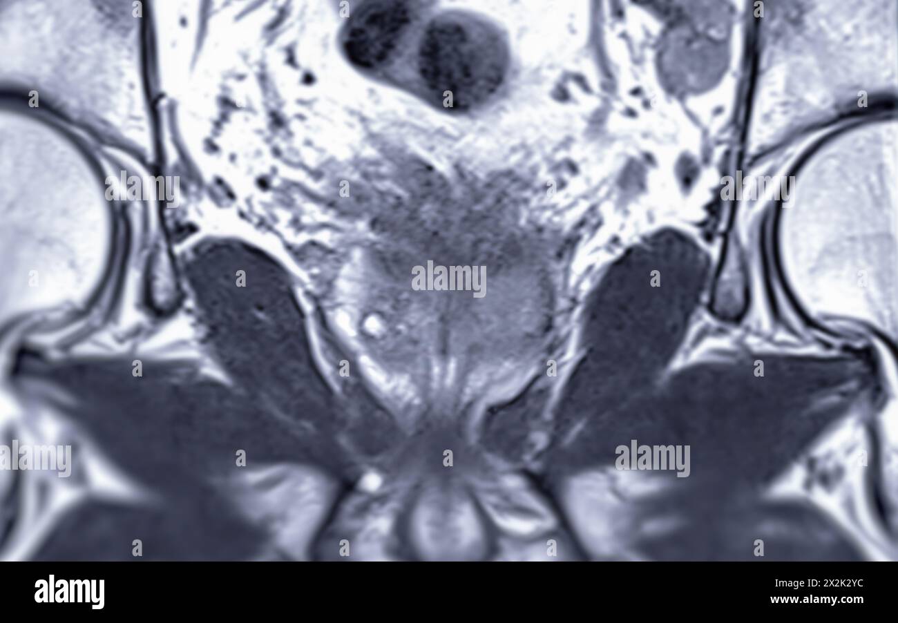 MRI of the prostate gland reveals Focal abnormal SI lesion at left PZpl at apex as described; PI-RADS category 4, clinically  significant cancer is li Stock Photo