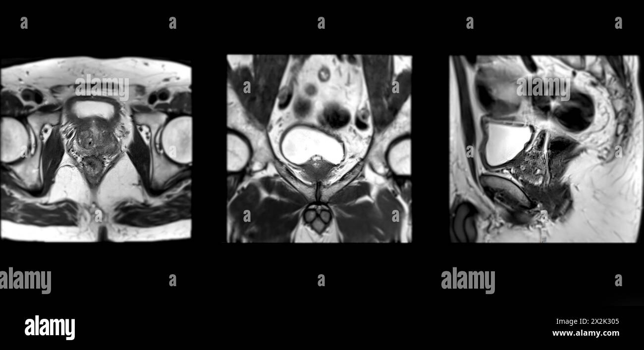MRI of the prostate gland reveals Focal abnormal SI lesion at left PZpl at apex as described; PI-RADS category 4, clinically  significant cancer is li Stock Photo