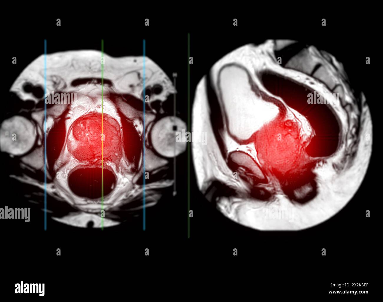 MRI of the prostate gland reveals a focal abnormal signal intensity (SI ...