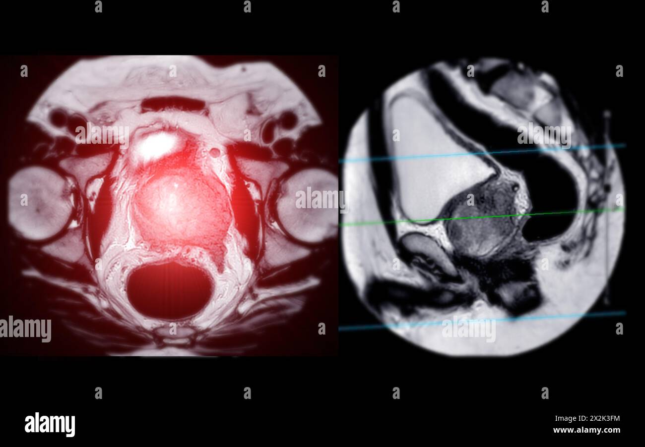 MRI of the prostate gland reveals a focal abnormal signal intensity (SI) lesion at the left posterolateral peripheral zones at the apex, aiding in dia Stock Photo