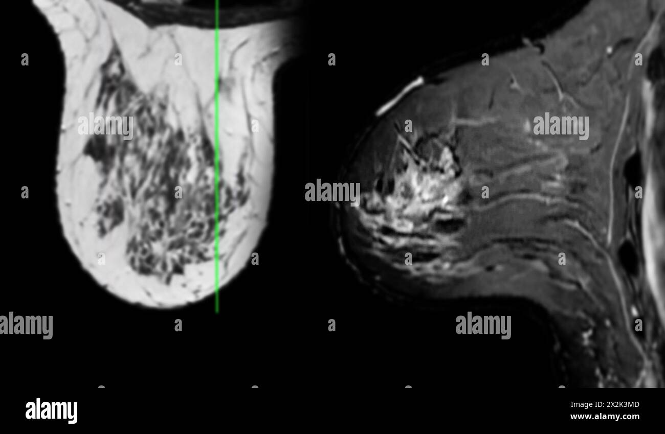 Breast MRI revealing BI-RADS 4 in women indicates suspicious findings warranting further investigation for potential malignancy and  biopsy to confirm Stock Photo