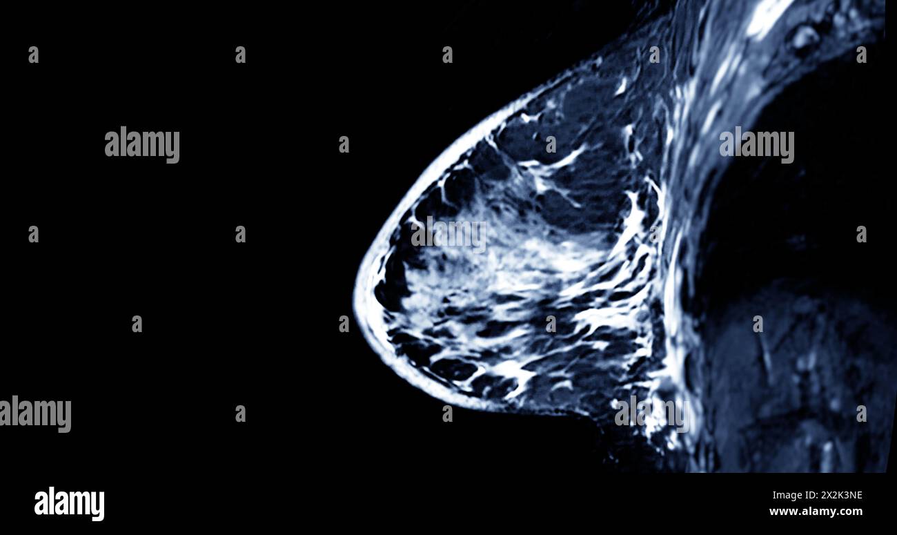 Breast MRI revealing BI-RADS 4 in women indicates suspicious findings warranting further investigation for potential malignancy and  biopsy to confirm Stock Photo