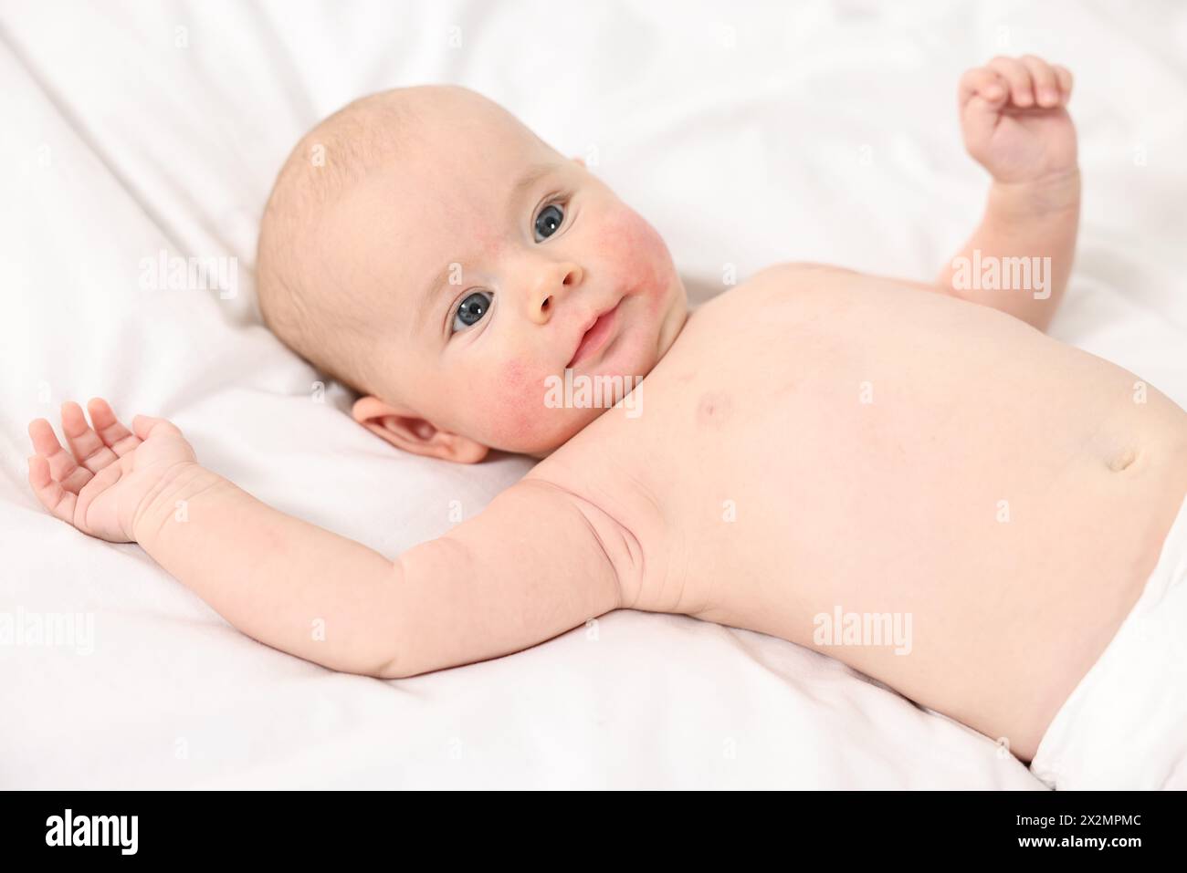 Cute little baby with allergic redness on cheeks lying on white blanket Stock Photo