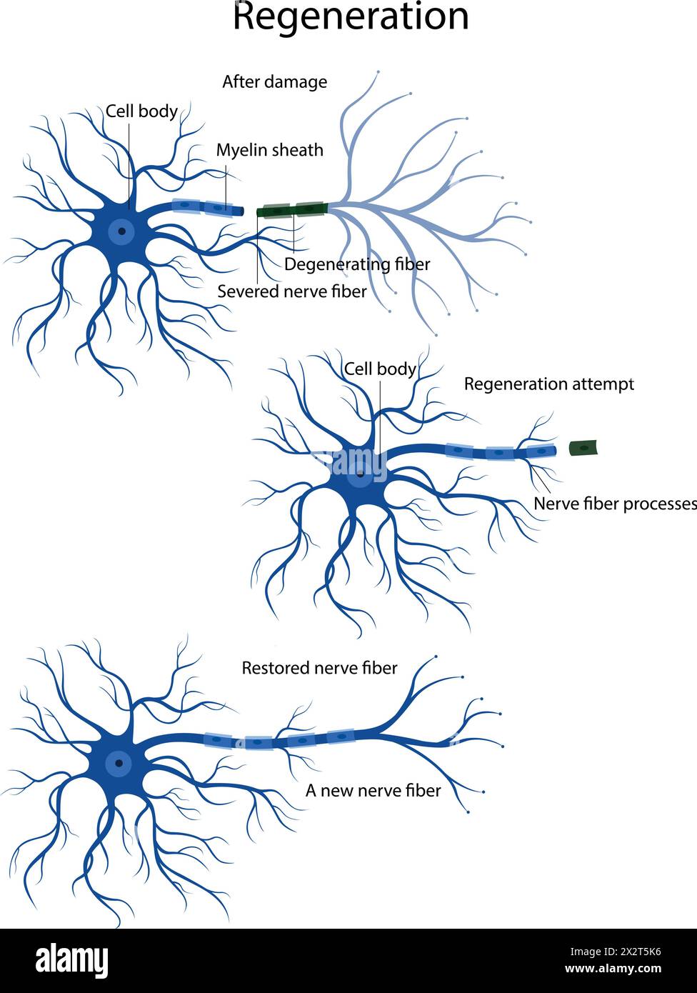 An attempt at nerve fiber regeneration. Damage and degeneration of the ...