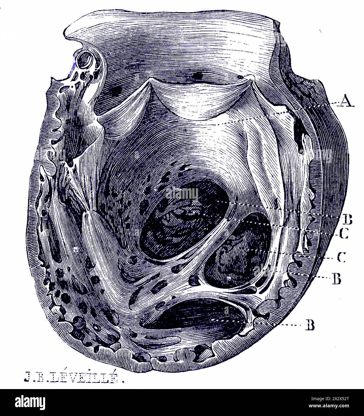 Illustration of the interior of the aortic arch from a patient with an ...