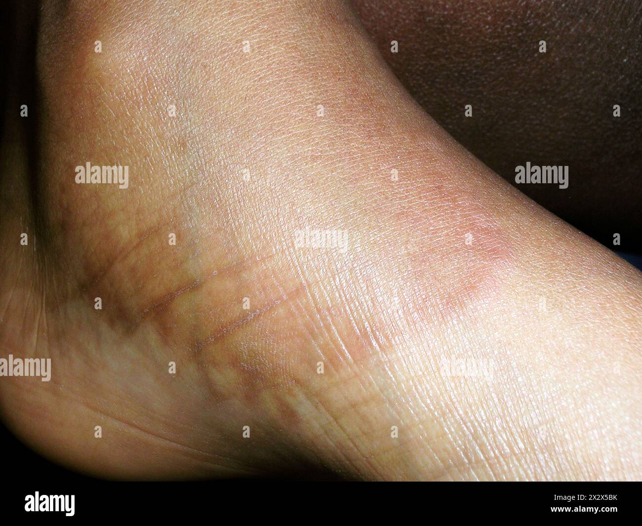 Granuloma annulare lesion on the foot of an eight year old African ...
