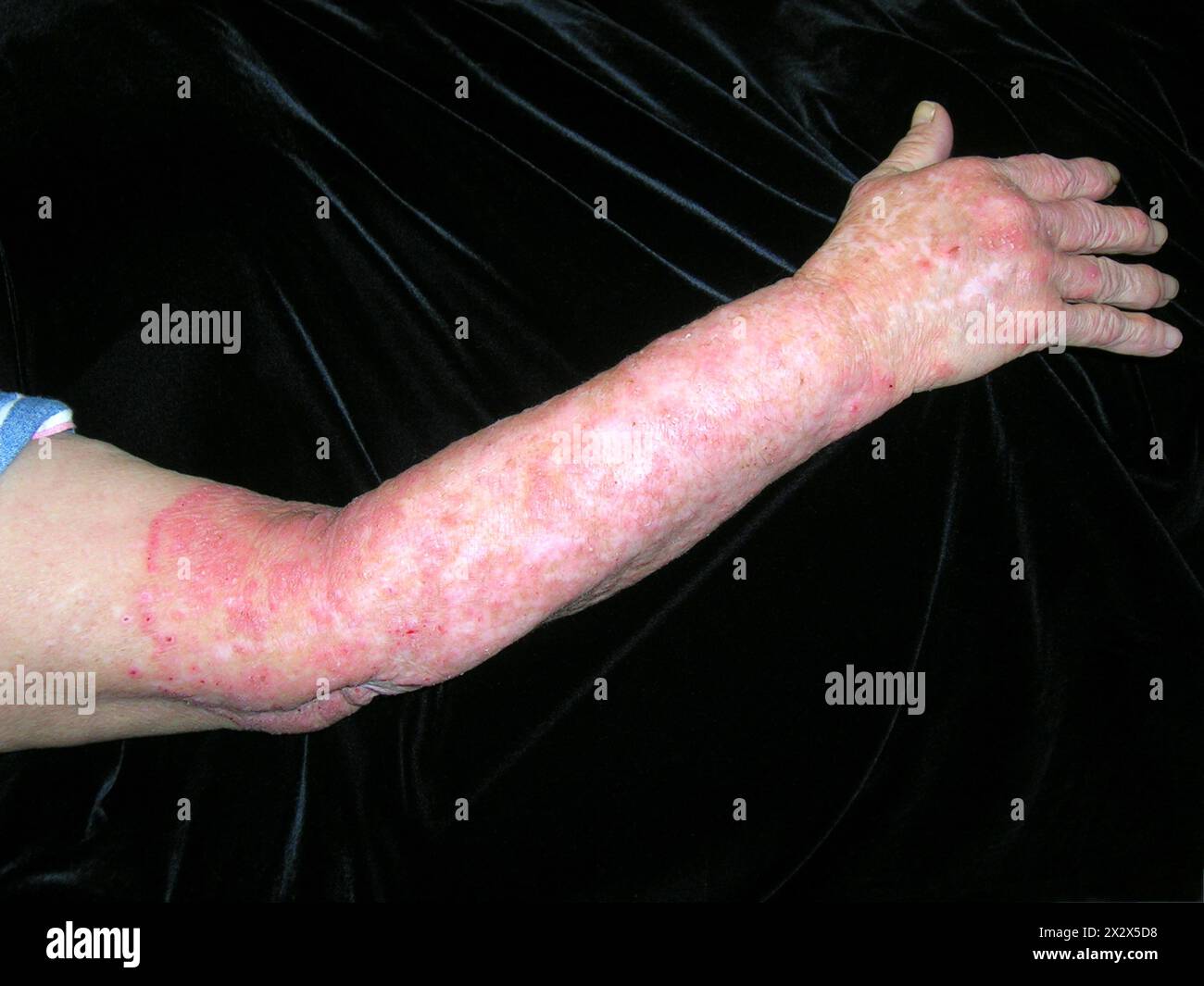 Ringworm infection on a Hispanic female patient's arm. Ringworm is a ...