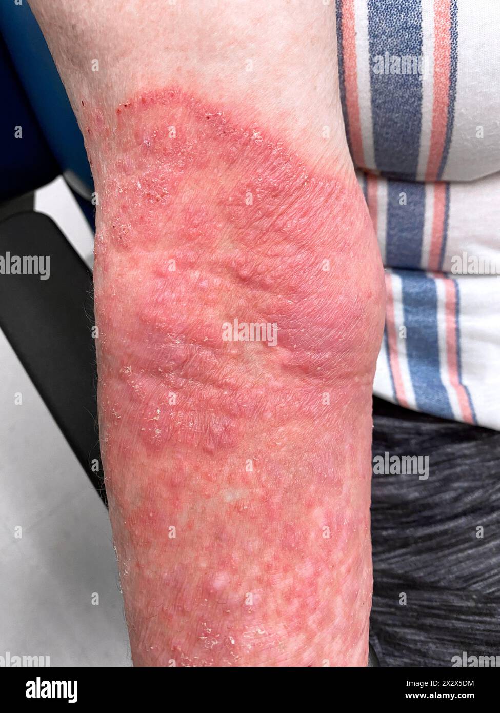 Ringworm infection on a Hispanic female patient's arm who has been ...