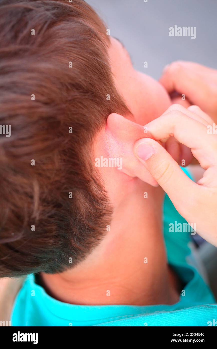 painful flaking and itching of skin behind ears of young boy Stock ...