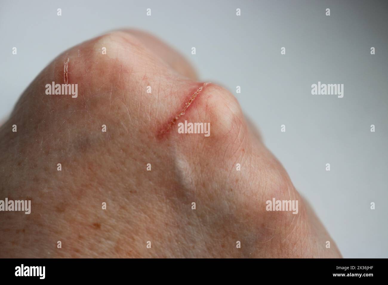 Close-up of a scratched wound on the hand of a mature woman. Selective Focus Stock Photo