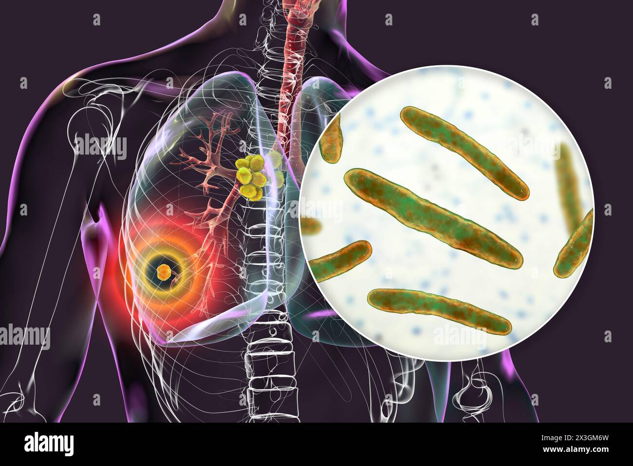 Illustration of primary lung tuberculosis, featuring the Ghon complex and mediastinal lymphadenitis with close-up view of Mycobacterium tuberculosis bacteria. Stock Photo
