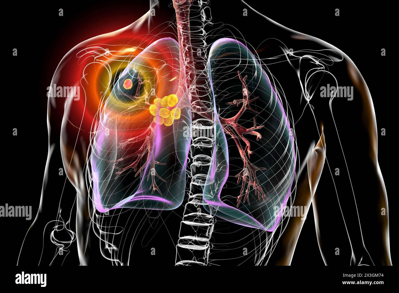 Illustration of primary lung tuberculosis, featuring the Ghon complex and mediastinal lymphadenitis. Stock Photo