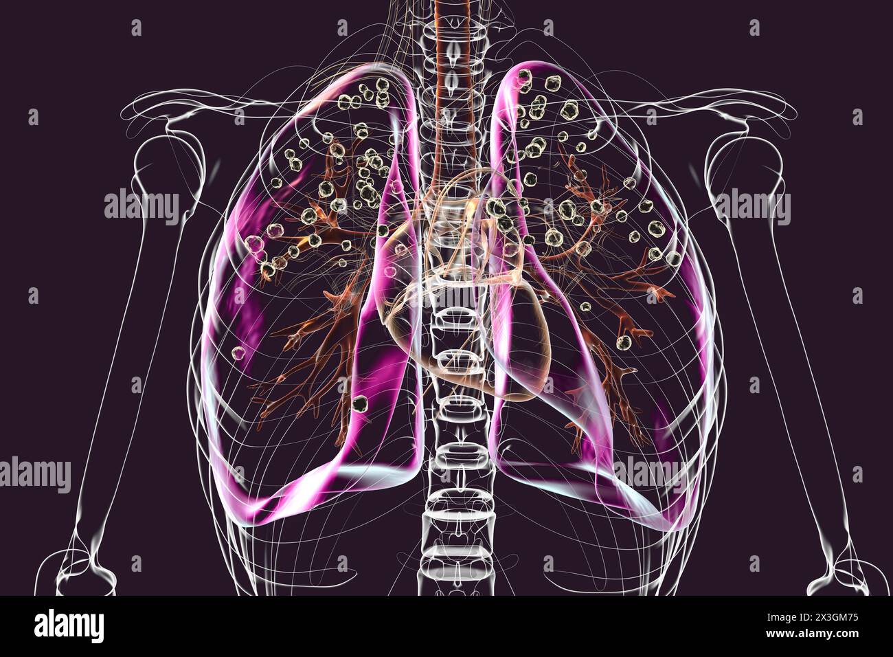 Illustration depicting lungs affected by silicosis within a transparent human body, emphasising respiratory health issues due to silica exposure and revealing dark silicotic nodules. Stock Photo