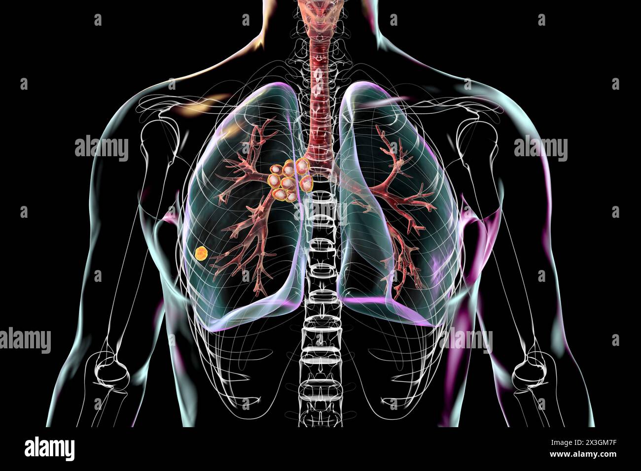 Illustration of primary lung tuberculosis with the Ranke complex, highlighting pulmonary lesions and mediastinal lymphadenitis. Stock Photo