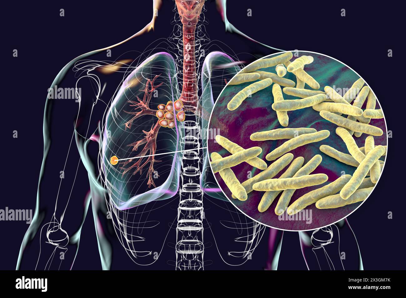 Illustration Of Primary Lung Tuberculosis With The Ranke Complex ...