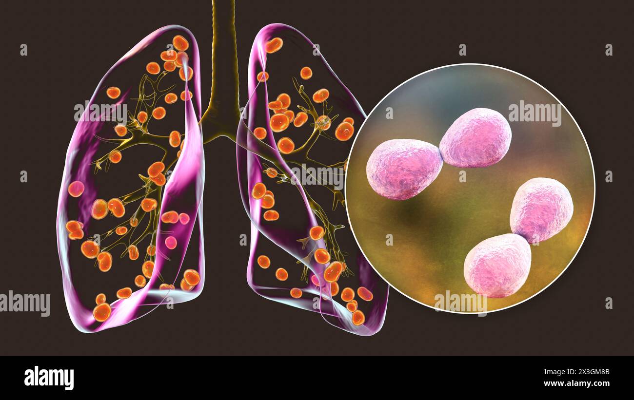 Illustration of lung histoplasmosis, a fungal infection caused by ...